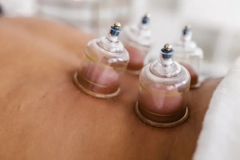How Can Cupping Therapy Aid Pain Management for Marin County Athletes?