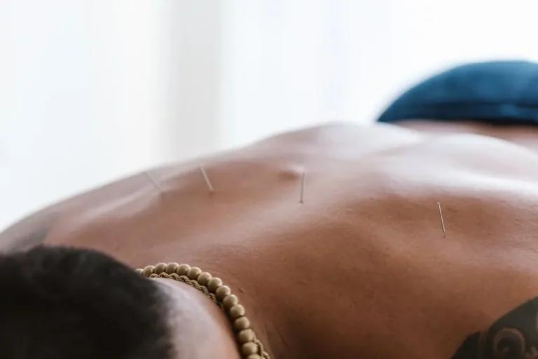 How Acupuncture Alleviates Chronic Pain for Bay Area Athletes