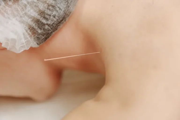 Dry Needling Explained: What You Need to Know