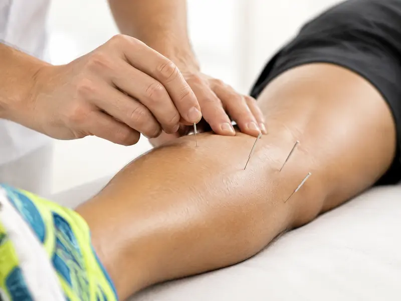 Fine acupuncture needles placed in a runner's calf
